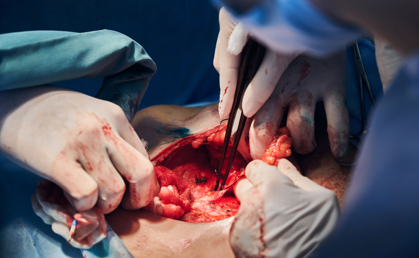 Surgery For Colorectal Cancer Ark Surgical Practice