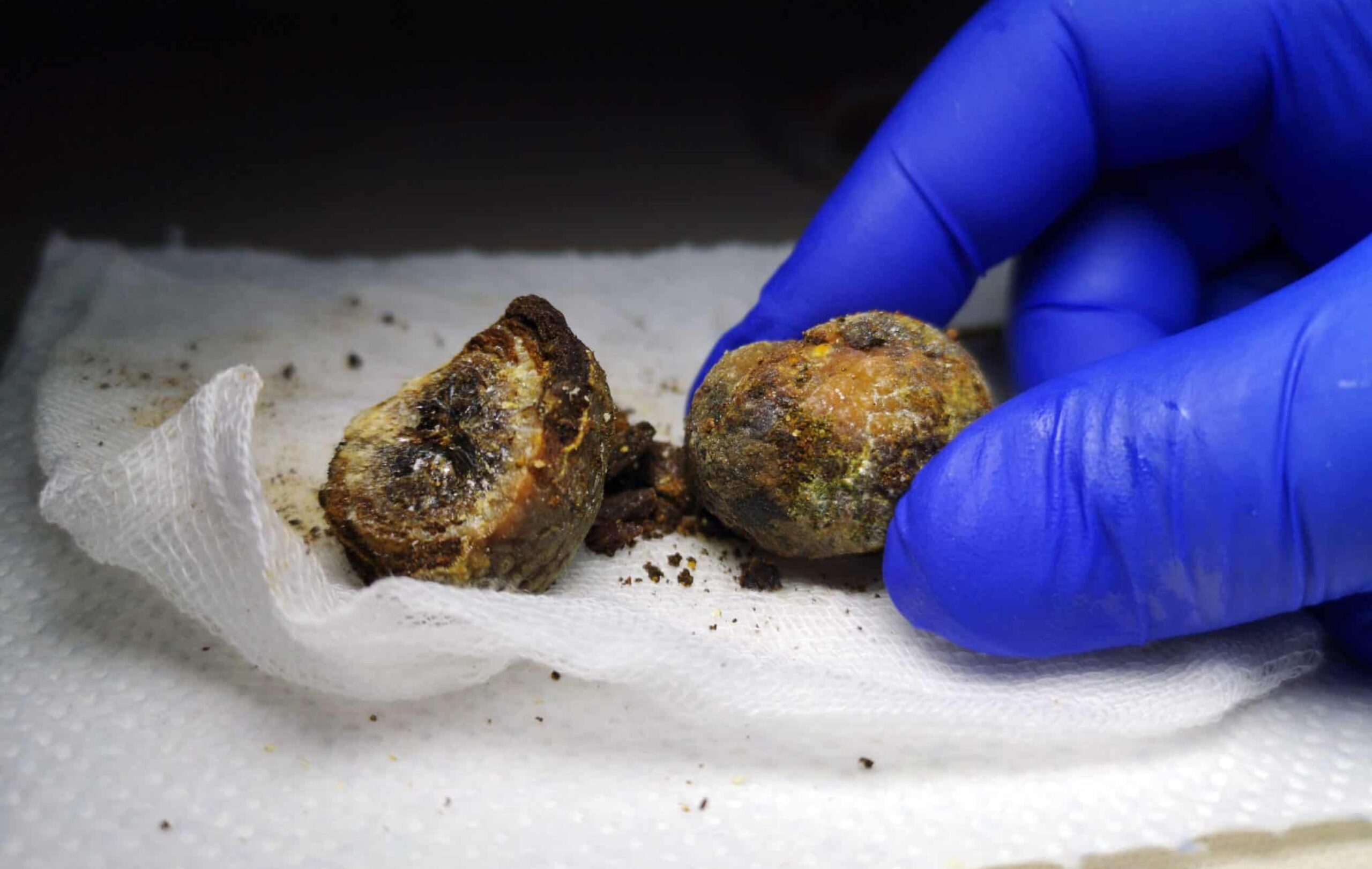 What Is Gallstone Surgery Ark Surgical Practice What Is Gallstone Surgery Ark Surgical Practice