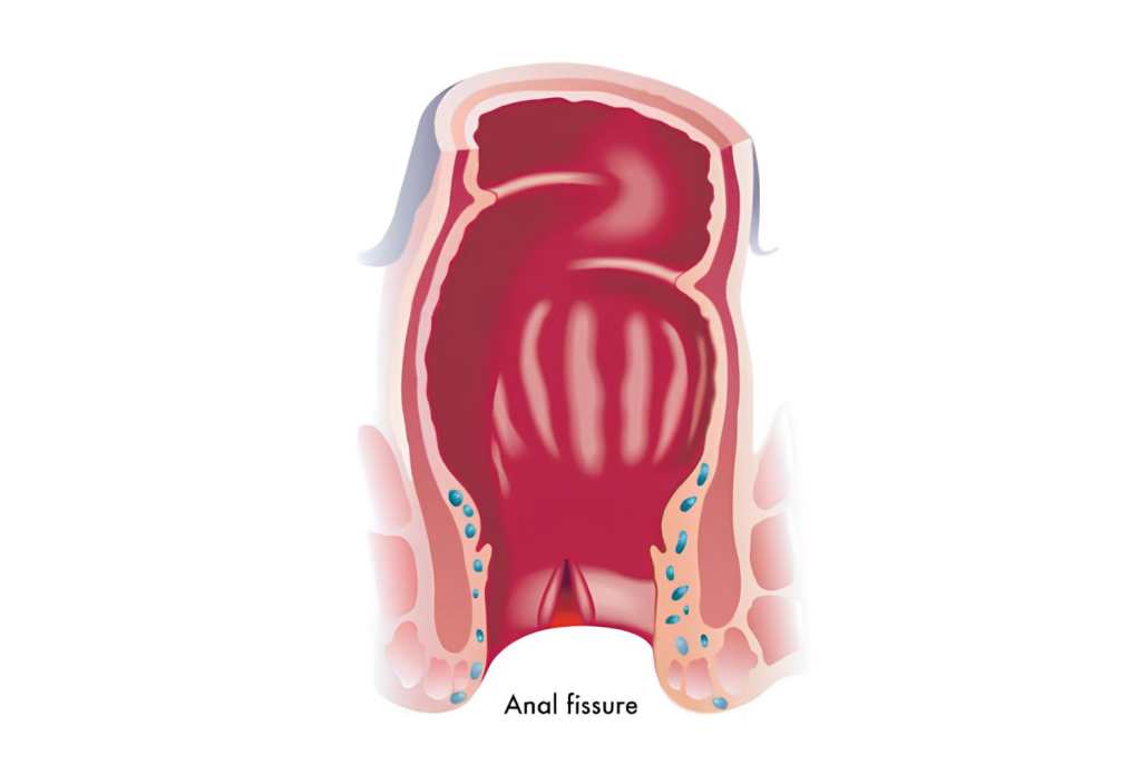 Anal Fissures Singapore