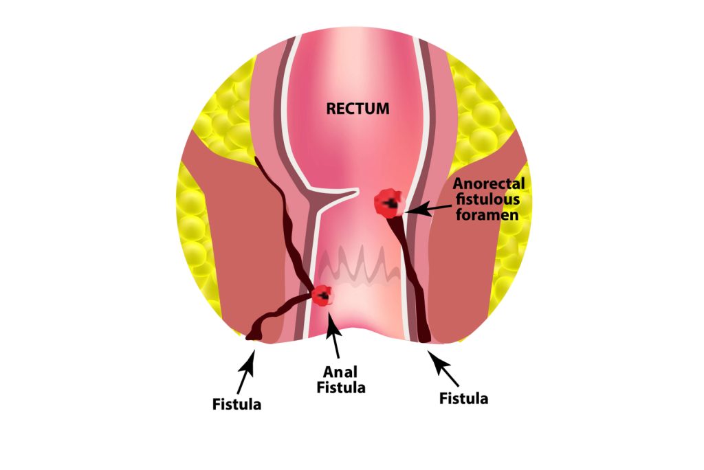 Anal Fistula Singapore