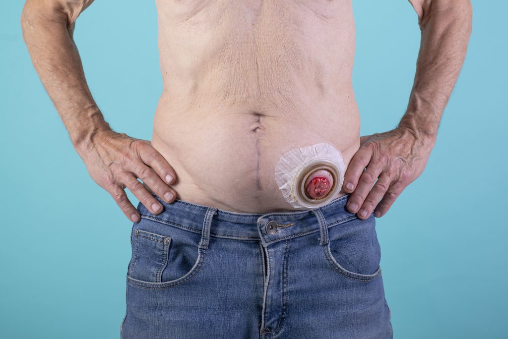 Abdominoperineal Resection (APR) Singapore