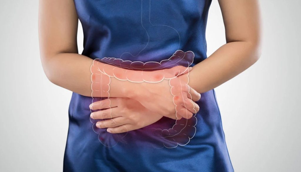 Colonic Ischaemia Singapore