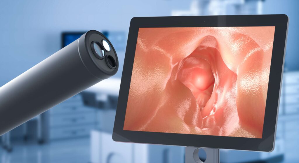 Picture Of Machine During Colonoscopy Procedure In Singapore