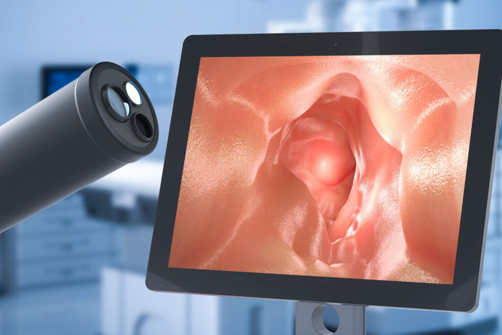 Colonoscopy