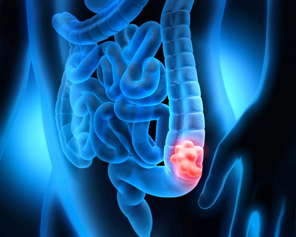 Colorectal Cancer Singapore