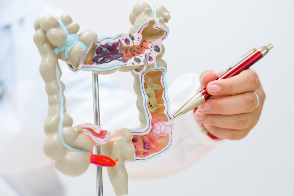 Colorectal Cancer Surgery Singapore