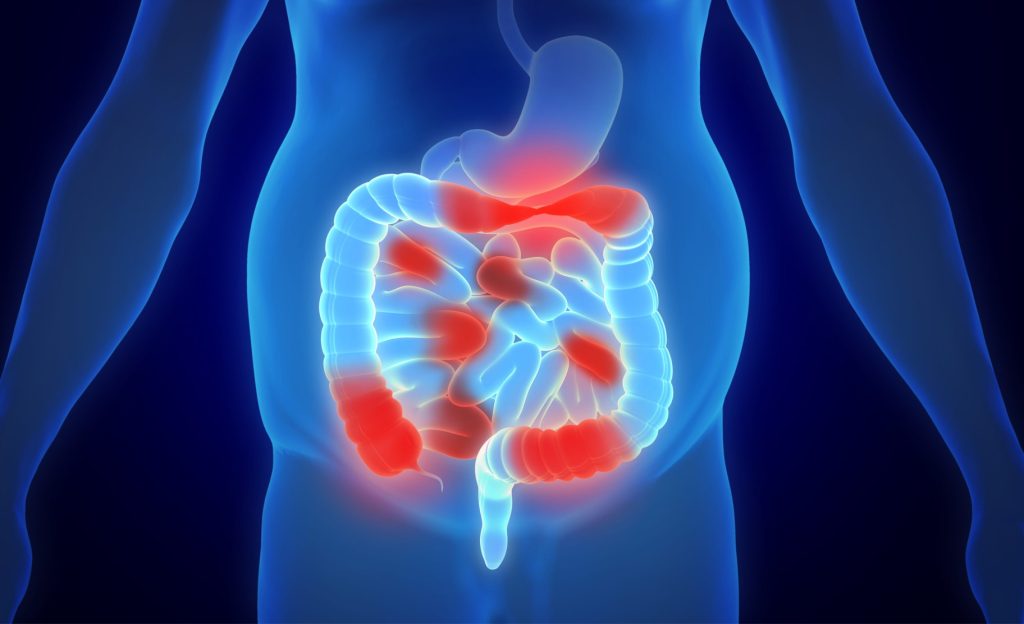 Crohn's Disease Singapore