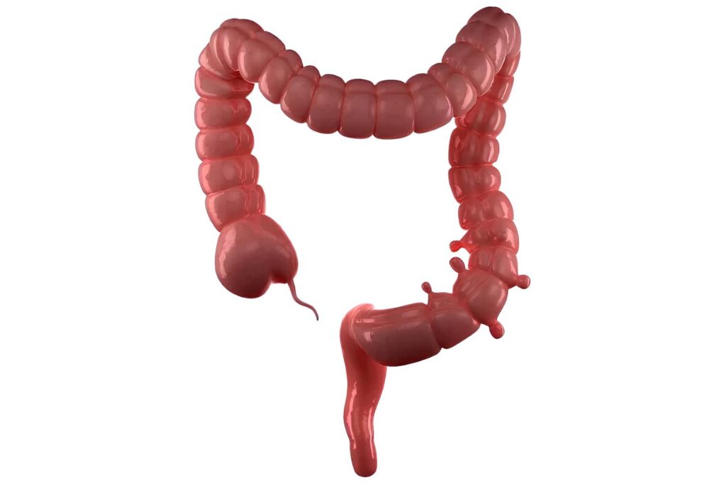 Diverticular Disease Singapore