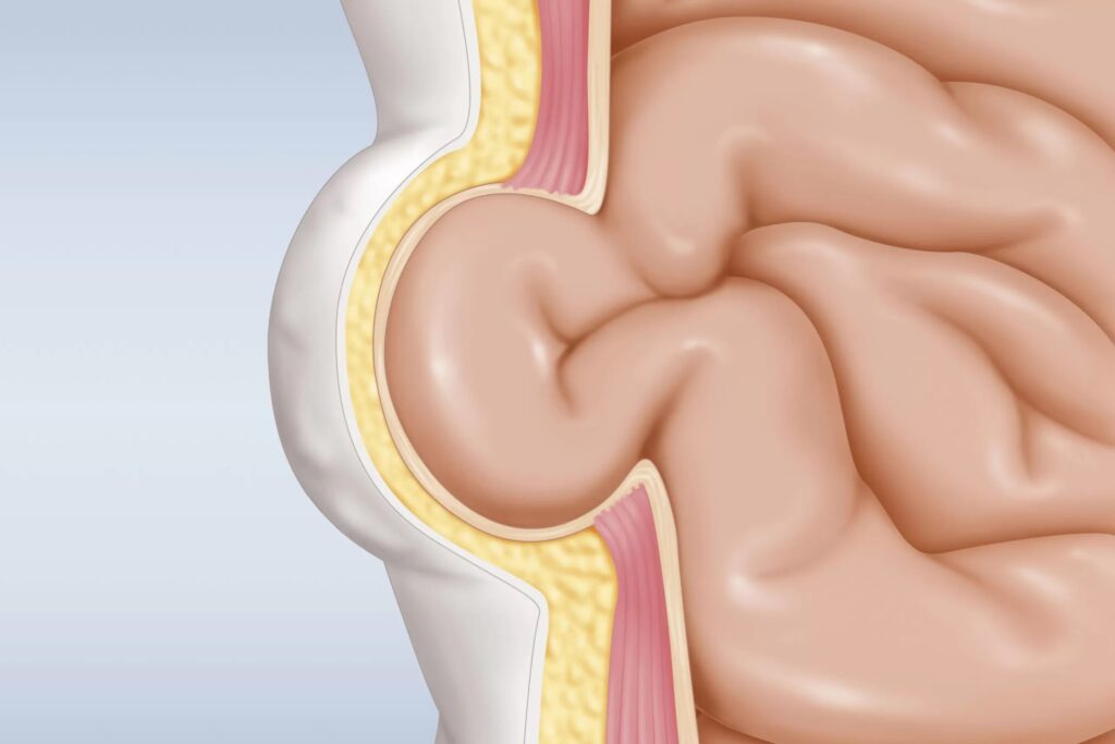 Laparoscopic Hernia Surgery Singapore