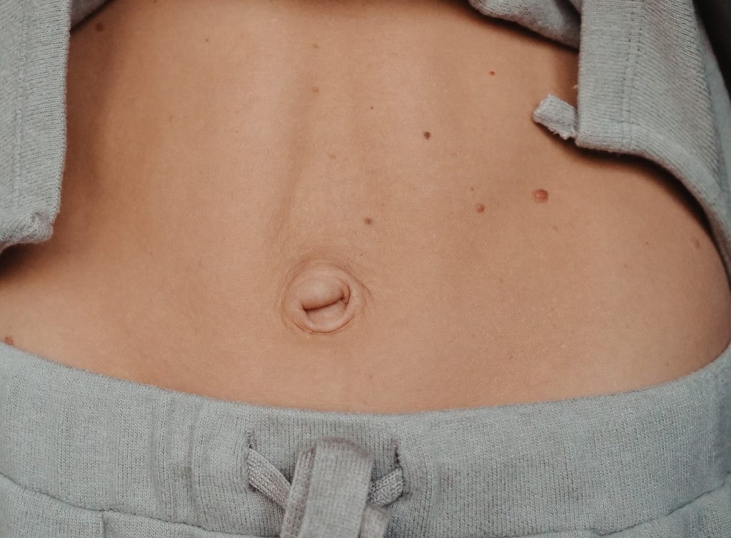 Umbilical Hernia Singapore