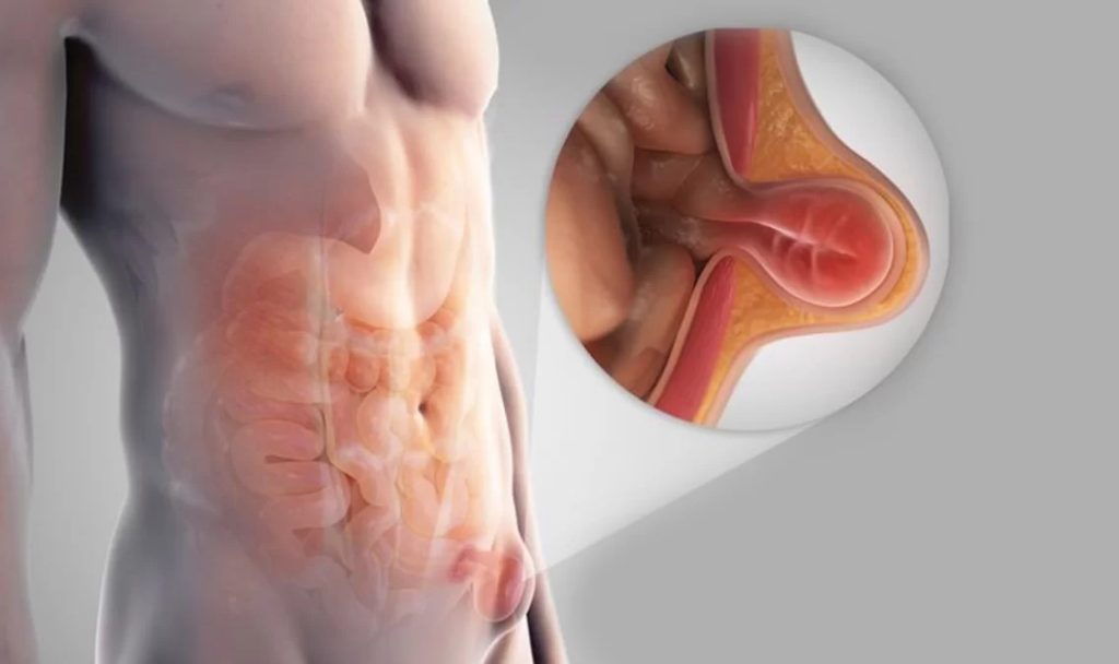 Inguinal Hernia Repair Singapore