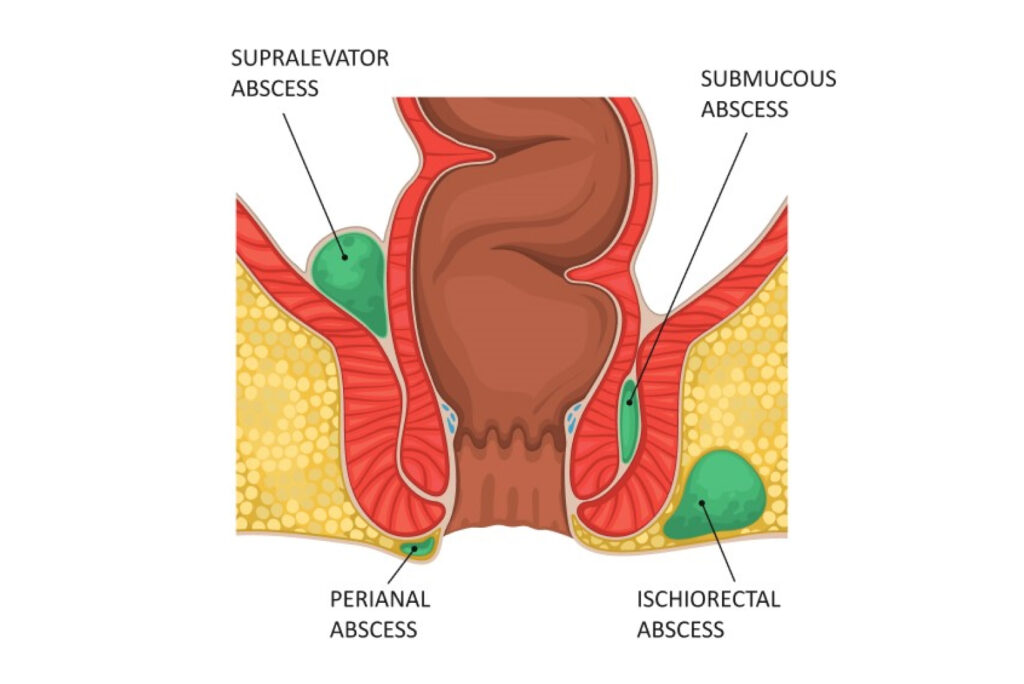 Perianal Abscess