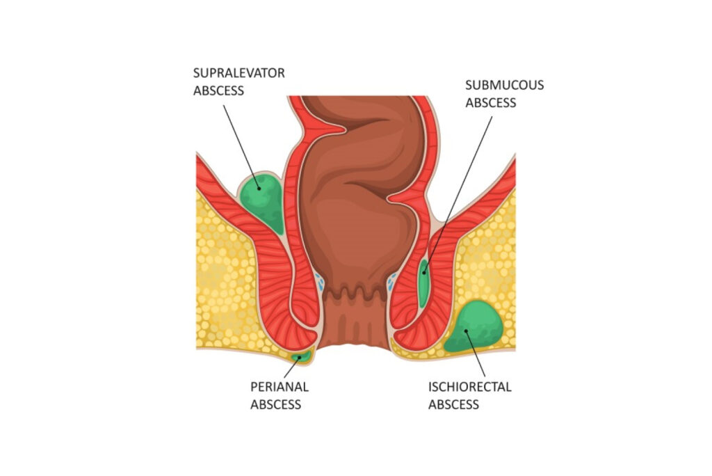 Perianal Abscess Singapore