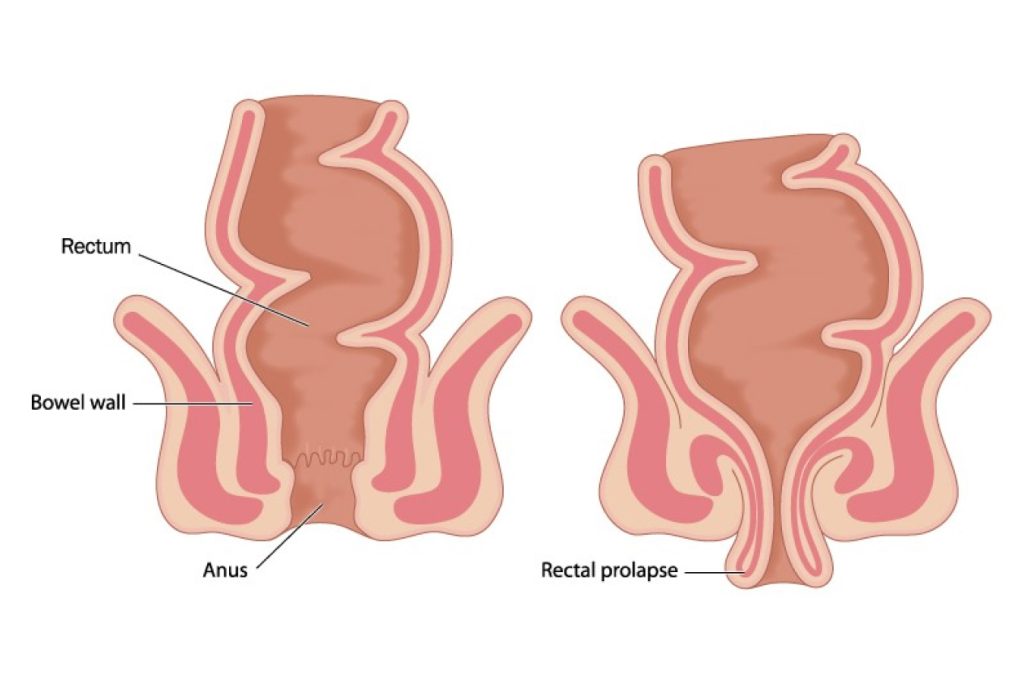 Rectal Prolapse Singapore