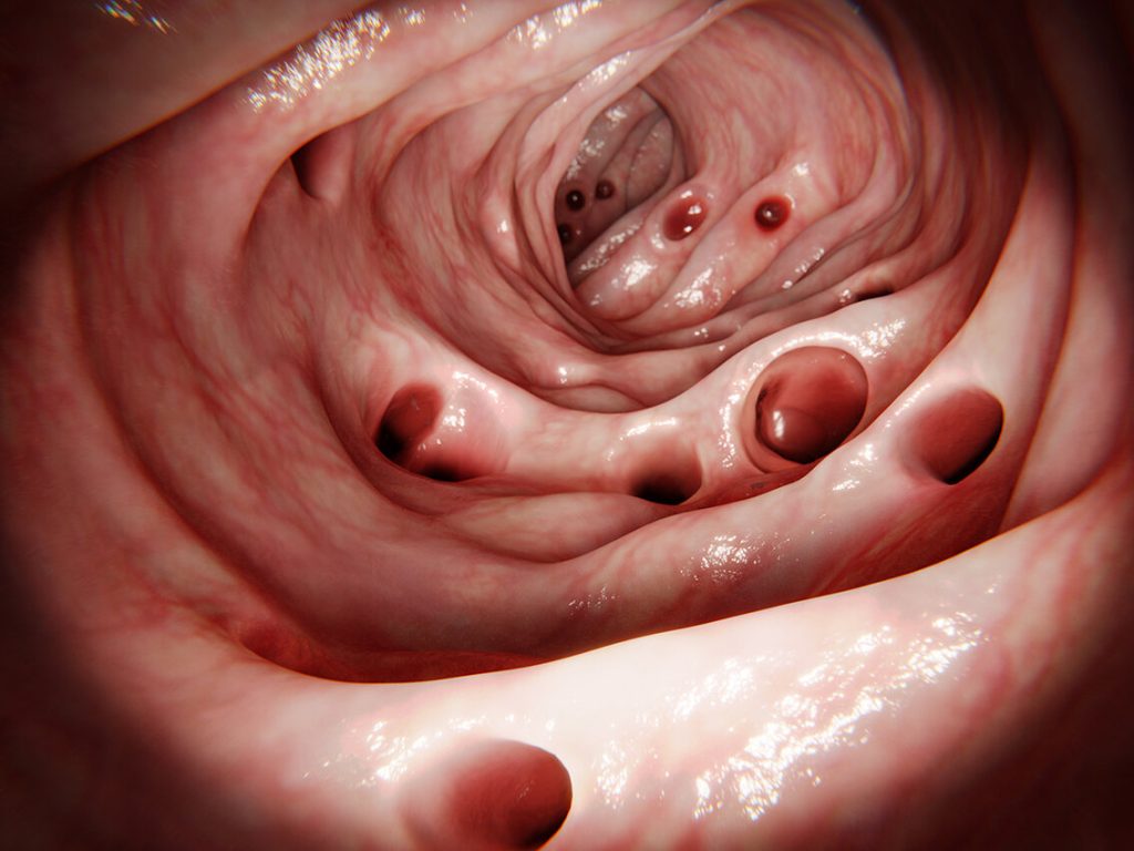 Diverticulitis Singapore