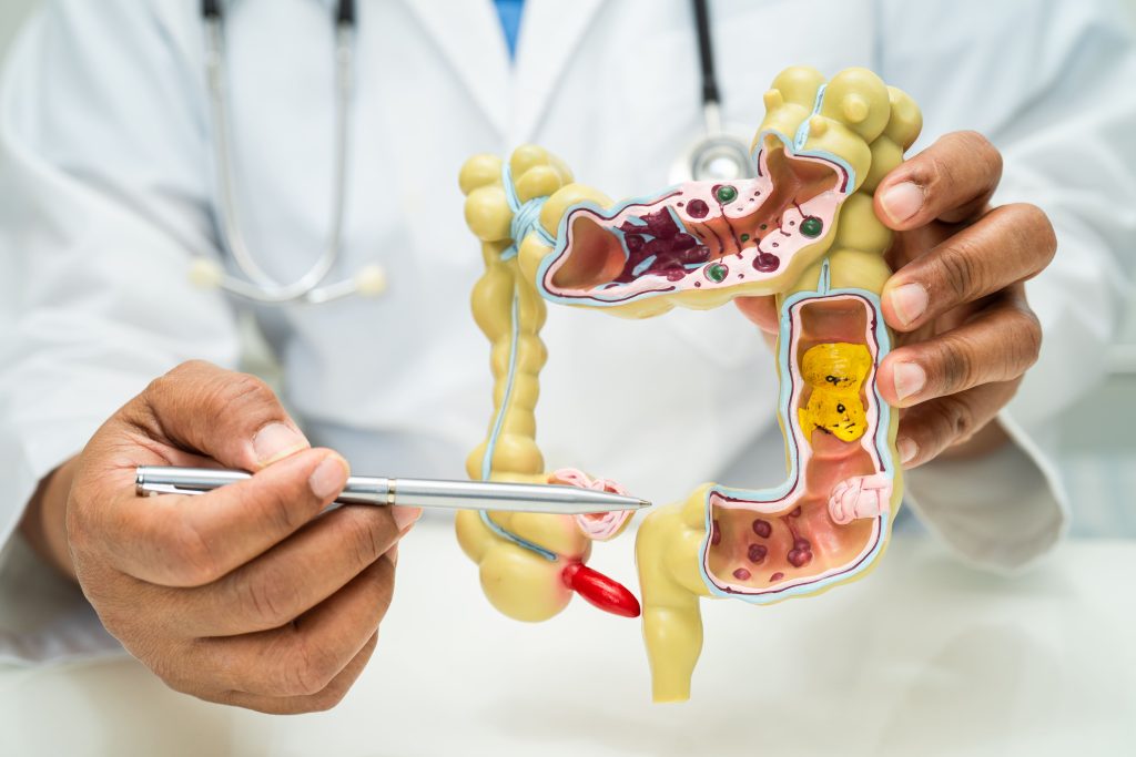 TransAnal Total Mesorectal Excision (TaTME)