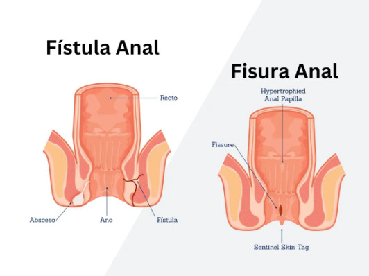 Anal Fissure vs Anal Fistula: Key Differences Explained