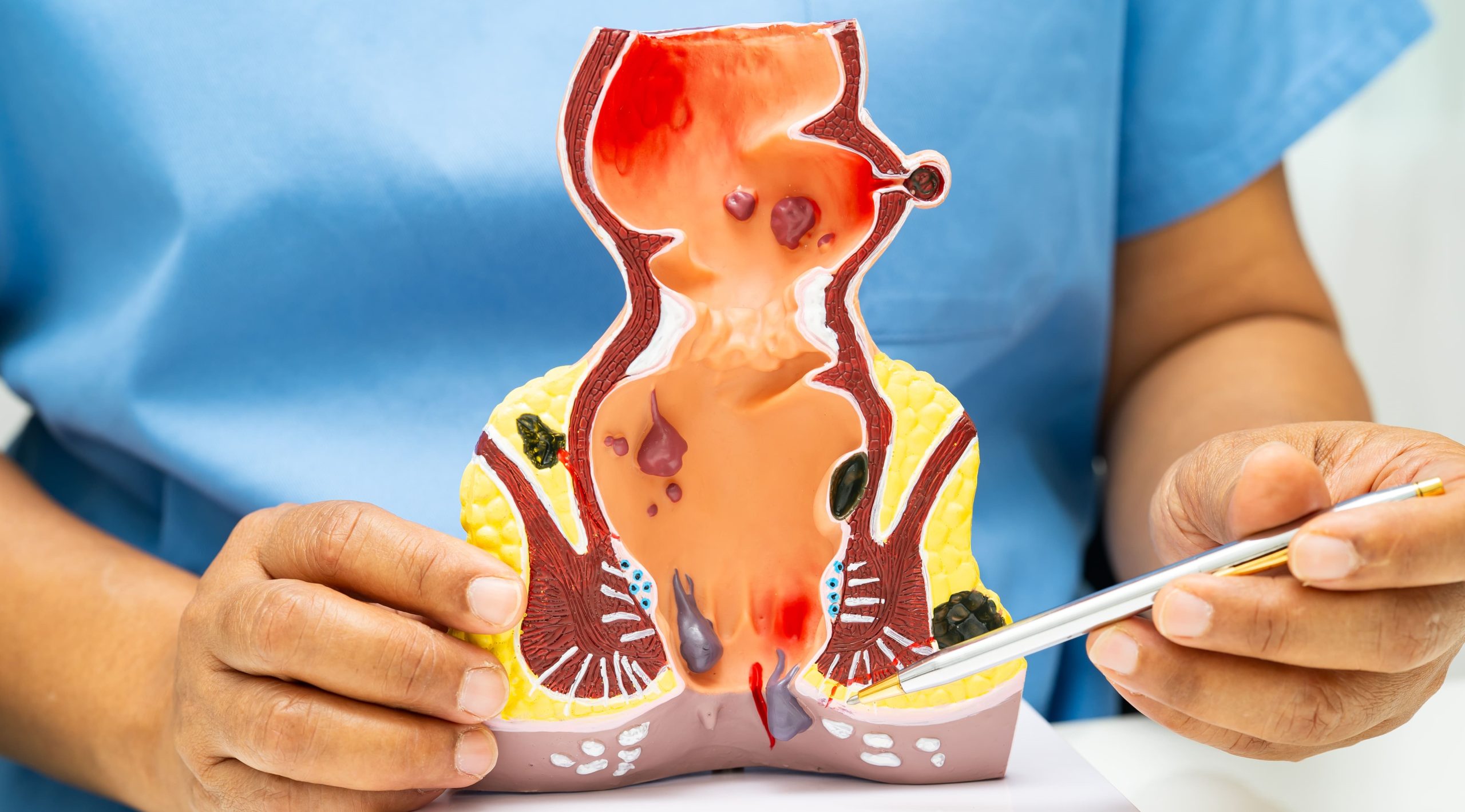 Rectal Prolapse vs Hemorrhoids: Key Differences Explained