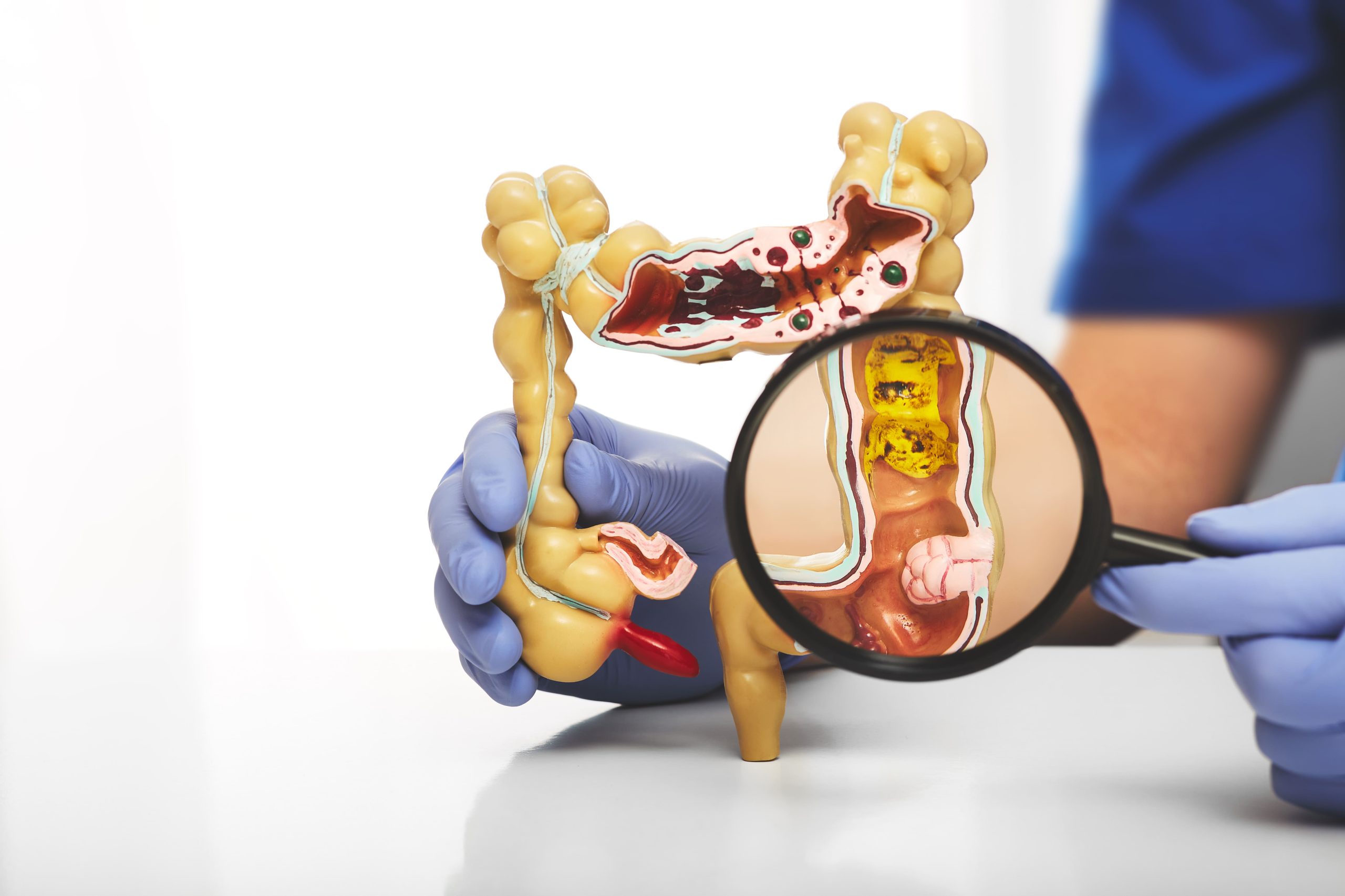 How to Prepare for a Colonoscopy: A Step-by-Step Guide - Ark Surgical ...