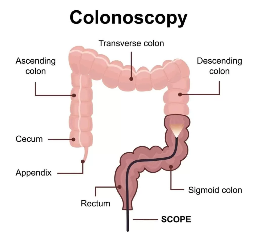 Infographics showing colonoscopy