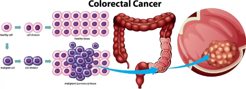 Infographics showing colorectal cancer progress